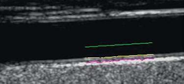 intima-media thickness appropriate evaluation and proper measurement described|intima media thickness.